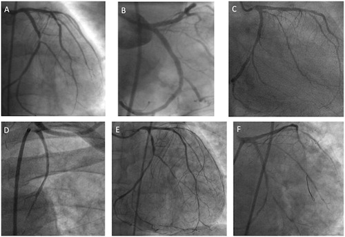 Figure 1. Panel A: coronary angiogram showing mild stenosis of mid-LAD and severe stenosis at proximal segment of dominant LCX; Panel B: angiographic image after bare metal stent implantation on proximal LCX; Panel C: coronary angiogram showing severe stenosis at the ostium of LM, multiple stenosis of middle LAD, first diagonal branches, and in-stent restenosis of LCX involving obtuse marginal branch. Panel D: angiogram showing occlusion of both by-pass grafts; Panel E: native coronary artery angiogram showing severe stenosis of ostial LM, moderate stenosis of mid-LAD, with diffuse disease of diagonal and septal branches; moderate in-stent restenosis on proximal LCX and severe; Panel F: angiographic image after bare metal stent implantation on LM. LAD, left anterior descending artery; LCX, left circumflex artery; LM, left main; NSTEMI, non-ST elevation myocardial infarction; PL, posterolateral branch.