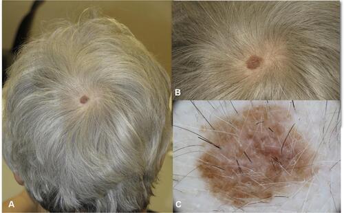 Figure 2 In situ melanoma of the vertex in a 68 year-old woman. (A) The lesion was arising in hair bearing scalp, the patient was not aware of the macule which was noticed by the hair dresser. (B) Close up clinical image, a flat brown macule 1 cm in diameter. (C and D) In dermoscopy atypical network and regression are detected. No non-prevalent benign pattern.