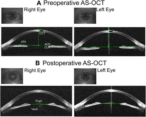Figure 2 (A) Preoperative measurements for the right and left eye using the AS-OCT chamber calliper. (B) Postoperative measurements Vault and Pupil diameter using linear callipers.