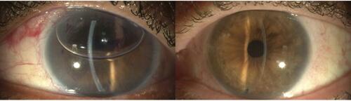 Figure 5 Early (left) and late (right) post DMEK transplantation. Note the perfect anatomical replacement of this procedure.Abbreviation: DMEK, descemet membrane endothelial keratoplasty.