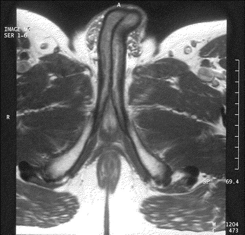 Figure 2.  MRI of the penis.