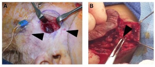 Figure 4 (A) Intraoperative photo demonstrating that IH can be easily separated from the surrounding soft tissue. Note facial monitoring devices in place. These can be used to assist during facial dissection. Course telangiectasia can be seen as well (arrowheads). (B) Feeding vessels to the IH need to be identified (black arrowhead) and isolated before dividing to minimize blood loss.