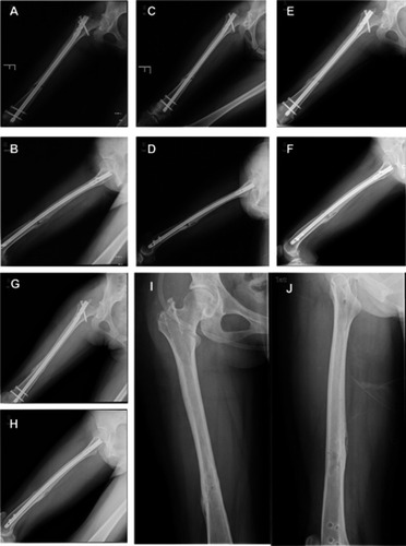Figure 4 Bone marrow (BM) transplantation of a 25-year-old female patient. (A and B) Radiographs of femoral shaft nonunion in a 25-year-old female patient; (C and D) postoperative result immediately after multidirectional percutaneous drilling and autologous concentrated BM transplantation; (E and F) 1 month postoperatively; (G and H) bony union, achieved 4 months postoperatively; (I and J) radiological results after removal of the intramedullary nail.