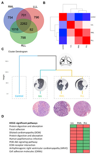 Figure 2 Transcriptome-assisted origin assessment of multiple ACC lesions. (A) The Venn diagram visualized the number of differential gene expression in the three tumors. (B) Heatmap of differential gene expression correlation matrices. (C) Hierarchical clustering and principal component analysis of gene expression profile. (D) KEGG signaling pathway analysis of DEGs in three tumors. Cells in green indicate the signaling pathways are significantly enriched, while cells in red mean the pathways are not activated.