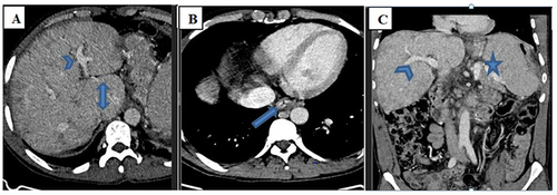 Figure 2 Axial (A and B) and coronal (C) portal venous phase abdominal CT scan at different levels show caudate lobe enlargement (double arrow on A), splenomegaly (star on C) and esophageal varices (arrow on B). The portal veins are patent (arrowheads on A and C).