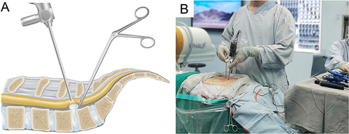 Figure 1 Overview of biportal endoscopic lumbar interbody fusion. (A) Illustration of unilateral biportal endoscopic discectomy; (B) the dominant hand was used for the working portal and the nondominant hand was used for the endoscopic portal.