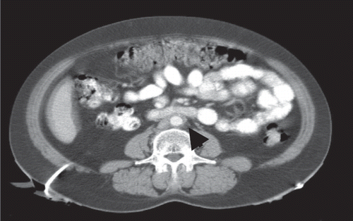 Figure 2. CT scan performed 3 months following steroid treatment demonstrated a decrease of the diameter of the fibrotic plaque from 14 mm to 8 mm.