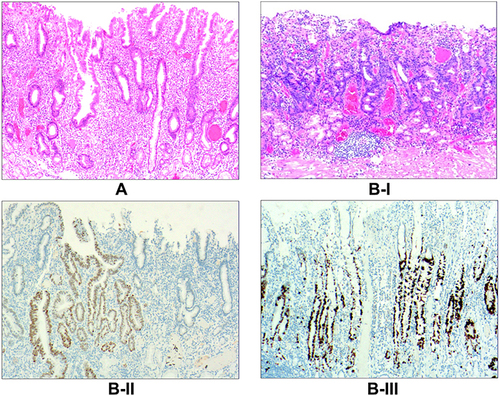 Figure 6 Stage V, intraepithelial neoplasia. (A) Stage VA involves low-grade intraepithelial neoplasia, where the glands exhibit irregular branching, glandular epithelial cells are present with mild-to-moderate atypia, the basophilic nature of the cytoplasm increases, the nuclei become longer, and the neoplasia is located at the base of the glandular epithelium with infiltration of stromal lymphocytes and plasma cells (hematoxylin and eosin [H&E] staining, ×200). (B) Stage VB involves high-grade intraepithelial neoplasia: I) the irregular branching of the glands is obvious, the glandular epithelial cells change from columnar to cuboid, with large nuclei, an increased nuclear-cytoplasmic ratio, and obvious nucleoli, while the mitotic figures increase (H&E staining, ×200); II) CDX2 expression is positive (EnVision method, ×100); III) in total, 30%–60% of the cells are Ki-67 positive (EnVision method, ×100).