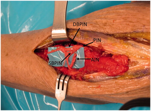 Figure 2. AIN brought dorsally through the interosseous membrane (IOM) where it reaches the PIN just at the level of bifurcation into superficial and deep branches.