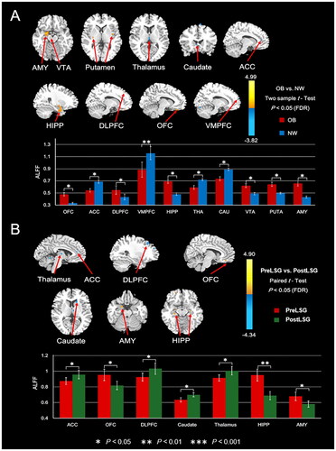 Figure 1. Functional mapping of brain areas demonstrating significant ALFF alterations between OB and NW groups, and between PreLSG and PostLSG groups during resting state (pFDR < 0.05). (A) Compared to NW, OB had increased ALFF in the OFC, DLPFC, HIPP, VTA, PUTA, and AMY, and decreased ALFF in the ACC, VMPFC, THA, and CAU. (B) LSG showed that PostLSG had increased ALFF in the ACC, DLPFC, CAU, and THA, and decreased ALFF in the OFC, HIPP, and AMY. ALFF: Amplitude of low frequency fluctuations; OB: patients with obesity; NW: normal weight; LSG: Laparoscopic sleeve gastrectomy; PreLSG: patients with obesity who had MRI scan before surgery; PostLSG: patients with obesity who received LSG and were scanned again 1 month after surgery; FDR: the false discovery rate; OFC: orbitofrontal cortex; DLPFC: dorsal lateral prefrontal cortex; HIPP: hippocampus; VTA: ventral tegmental area; PUTA: putamen; AMY: amygdala; ACC: anterior cingulate cortex; VMPFC: ventral lateral prefrontal cortex; THA: thalamus; CAU: caudate.