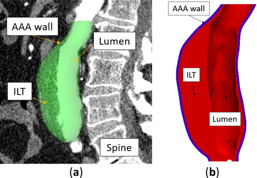 Figure 1. Example of patient-specific abdominal aortic aneurysm (AAA) geometry (Patient 1): (a) AAA model segmented from CTA image – sagittal view, and (b) a cross-section of AAA geometry showing the intraluminal thrombus (ILT), lumen, and AAA external wall (blue color) created automatically using BioPARR (Joldes et al. Citation2017).