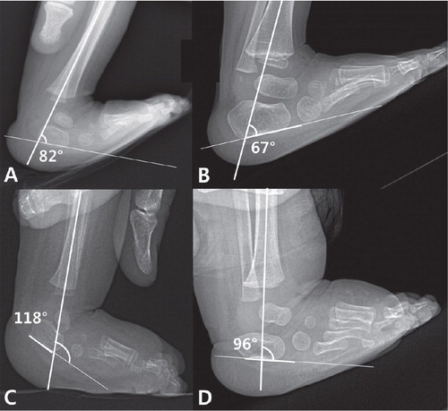 Radiographic measurement of the lateral tibiocalcaneal angle in each group of patients. A. A lateral tibiocalcaneal angle of 82° before PAT in a 3-month-old infant. B. The same infant at 15 months of age; the lateral tibiocalcaneal angle was 67°. This child was assigned to group 1. C. A lateral tibiocalcaneal angle of 118° before percutaneous Achilles tenotomy in a 3-month-old infant. D. The same infant at 12 months of age; the lateral tibiocalcaneal angle was 96° before selective soft tissue release was performed to treat the residual equinovarus deformity. This child was assigned to group 2.