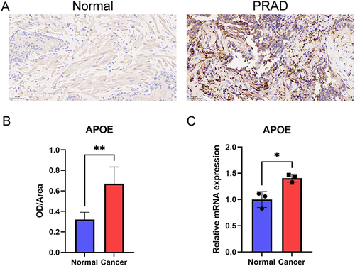 Figure 10 IHC staining validation and qRT-PCR. (A) IHC staining was applied to validate the differential expressions of APOE using PRAD samples. Scale bar = 50 µm. (B) ImageJ software was used to evaluate the relative expression of APOE, which was expressed as optical density (OD). (C) Comparison of APOE gene mRNA expression between normal and tumor tissues in PRAD. *P < 0.05, **P < 0.01. Data are expressed as mean ± SEM.