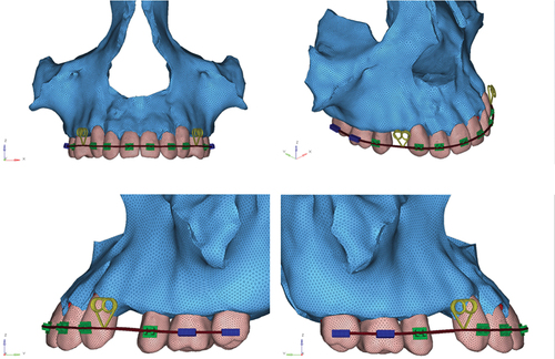 Figure 4. Finite element analysis model of maxillary bone and dentition along with Specs loop.