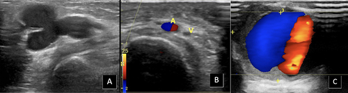 Figure 3 Ultrasound of the cannulation complications from vascular access in ESKD patients: (A) Giant draining vein shown as an enlarged draining vein more than 2 cm in diameter; (B) Acute hematoma visible as hypoechoic appearance without internal blood flow during color Doppler; (C) The yin-yang sign on Doppler ultrasound within the pseudoaneurysm.