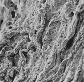 Figure 4 Elastic fibers three-dimensional disarray, fragmentation, and diastases with clefts similar to the big ones in the convexity, ×1,500.