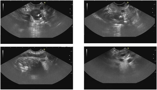 Figure 3. The pancreatic body and tail parenchyma appear atrophic, patchy calcification can be seen at the head of the pancreas, and multiple anechoic structures can be seen on the side of the pancreatic head. The adjacent duodenal wall is thickened with cysts of the duodenal wall.