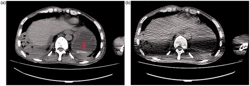 Figure 2. Axial CT images without contrast of a 48-year-old man: (a) standard dose CT image reveals hyperdense content within the dependent portion of stomach (arrow) likely representing ruptured package which cannot be clearly seen in low dose images (b).