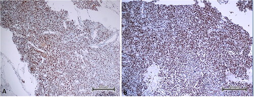 Figure 2. Strong nuclear EBP50 expression seen in some cases of LMS. A, B. Diffuse, nuclear EBP50 expression in two LMS cases (immunoperoxidase, 100×). Scale bar = 500 µm.