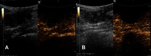 Figure 3 The contrast enhanced ultrasonography images before (A) and 48 minutes after treatment (B). (A) The left image shows a 3.0 cm irregular, hypoechoic mass with obscure boundary at right breast, located beside the nipple. The right image shows the blood flow signal inside the mass 52 seconds after contrast injection. (B) The left image shows the echo of mass enhanced; the right image shows non-contrast enhancement in the mass because of the vessel occlusion caused by high intensity focused ultrasound ablation.