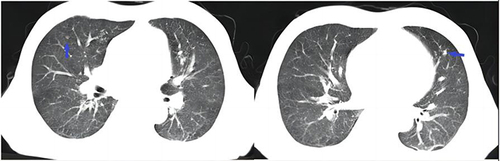 Figure 1 Chest CT: Chronic inflammation in both lungs, nodules visible in both lungs (as indicated by the blue arrows).