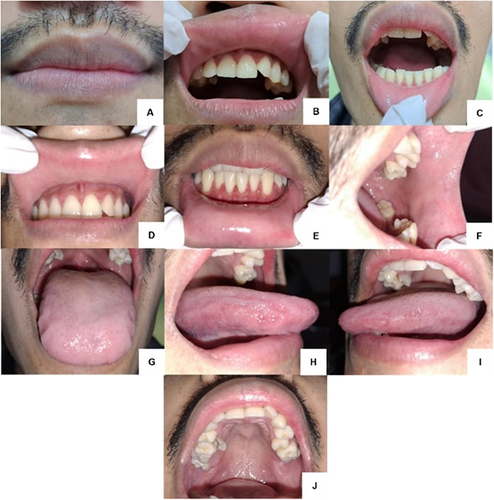 Figure 2 Clinical features of the patient’s lips and oral cavity in the last follow-up (A–J).