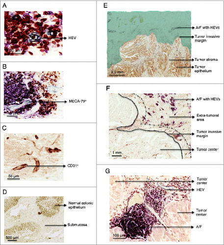 Figure 1. Immunohistochemistry staining of MECA-79+ and CD31+ vessels, CD3+, CD20+ cells in paraffin-embedded formalin fixed samples of healthy colon and colorectal tumor. (A) Detail of a HEV in gray (MECA-79+). Consecutive sections stained with (B) MECA-79 (gray), CD3 (brown), CD20 (pink) and (C) CD-31. (D) Representative example of a healthy colon lacking lymphoid A/F. The section was stained with anti-CD3, CD20 and MECA-79. (E) Overview of a colorectal adenocarcinoma. The area highlighted in green illustrates the extra-tumoral area, surrounding the tumor but not the tumor itself. HEVs were located in the extra-tumoral area at the advancing tumor invasive margin. (F) Lymphoid aggregates were located ahead of the tumor edge/tumor invasive margin. The area between the black line and the dashed line indicates where T cells were enumerated. The distance between these two lines is equivalent to one high power field at 600x magnification. (G) Detail of a lymphoid aggregate/follicle with a HEV within the tumor center. HEV, high endothelial venule. A/F, lymphoid aggregates/ follicles.