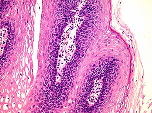 Figure 3 An incisional diagnostic biopsy of oral mucosa showed squamous epithelial papillary hyperplasia. (HE, ×200).
