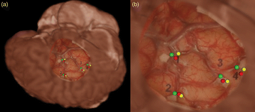 Figure 7. Clinical evaluation. (a) Fusion of the photographic image onto the MR brain model and reconstructed landmarks in the clinical study. (b) Magnification of the region of interest in (a).