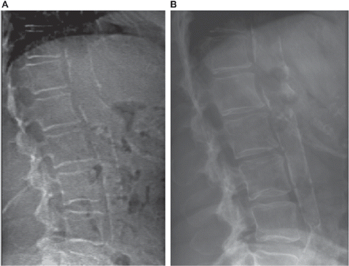 Figure 1. An example of severe AAC (score 8) with conventional X-ray (A) compared with VFA DEXA (B).