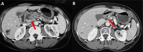 Figure 2 CT scans of a 63-year-old male patient with LAPC who received HIFU treatment.Notes: (A) Before treatment, pancreatic cancer invaded local blood vessels. An irregular low-density mass with 2.6×3.0 cm could be seen in the head of the pancreas. The boundaries between the lesion and the hepatic artery, superior mesenteric vein, and the proximal end of the splenic vein were unclear, and the pancreatic duct was dilated. (B) One year after HIFU treatment, the pancreas atrophied, a small amount of pancreatic tissue was seen on the head of the pancreas, no obvious space-occupying lesions were seen, the gap of peripancreatic fat was clear, and there was no sign of pressure on the surrounding blood vessels.Abbreviations: HIFU, high-intensity focused ultrasound; LAPC, locally advanced pancreatic cancer.