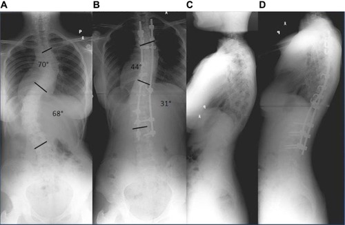 Figure 2 Surgical treatment of idiopathic scoliosis using posterior instrumentation. (A and C) Preoperative anteroposterior and lateral standing radiographs of an adolescent girl with progressive idiopathic scoliosis Lenke type 6CN. (B and D) Postoperative standing radiograph of the patient after hybrid-type posterior instrumentation. Satisfactory correction, increased trunk height, and a well balanced spine are seen in both the sagittal and coronal planes.