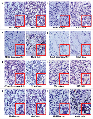 Figure 2. Immunohistochemical staining on luminal B breast cancer tissue for PD-1 (a), PD-L1 (b), TIM-3 (c), GAL-9 (d), CTLA-4 (e), CD4+ (f), CD8+ (g) and CD68 (h). After antigen retrieval on deparaffinized rehydrated sections, endogenous peroxidases were blocked using hydrogen peroxide (Riedel-de Haën, Seelze, Germany) while endogenous avidin and biotin were blocked using an avidin/biotin blocking kit (Invitrogen, Camarillo, USA). Sections were sequentially incubated with a protein block containing fetal calf serum, bovine serum albumin and human plasma to prevent background staining; then incubated with unconjugated primary antibodies or isotype controls; washed; linked first to biotinylated goat anti-rabbit IgG (Vector Laboratories, Burlingame, USA) or biotinylated goat anti-mouse IgG1 (Biolegend, San Diego, USA) secondary antibodies, then to streptavidin-conjugated horseradish peroxidase. Staining was visualized using hydrogen peroxide in 3,3-diaminobenzidine (Sigma Aldrich, St Louis, USA) counterstained with Harris' haematoxylin. Sections were dehydrated before mounting with Entellan mounting media (Merck Millipore, Darmstadt, Germany). In place of isotype controls for the polyclonal rabbit primary antibodies, TIM-3 (c), GAL-9 (d) and CTLA-4 (e), a secondary antibody-only stain was prepared. Curtin University (Perth Western Australia) and Bellberry (South Australia) Human Ethics Committees approved this study (approval numbers HR 107/2015 and 2015–03–151, respectively).