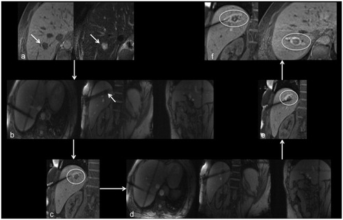Figure 2. Images of a 56-year-old male patient with metastasis of a mixed adenoneuroendocrine carcinoma in segment VIII. Metastasis is clearly depictable in planning imaging without administration of intravenous contrast agent (a; arrows). During first targeting with MR fluoroscopy (b) the applicator was positioned toward the cranial part of the metastasis (arrow). After ablation for 10 min with 18 kJ there is no coagulated tissue visible on the caudal part in monitoring (c; circle). Therefore, the applicator was repositioned (d) for an additional ablation for 15 min with 27 kJ toward the caudal part of the metastasis (e; circle). On final postprocedural imaging (f) there is a well-defined, T1-weighted hyterintense, oval shaped ablation zone with a 4 mm safety margin. No local recurrence was observed during follow-up.