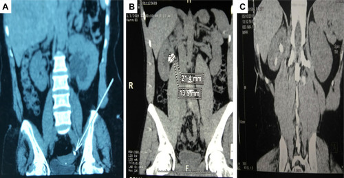 Figure 1 (A) NCCT coronal view showing a left distal ureteric stone at ureterovesical junction. (B) NCCT coronal view showing a right renal pelvis stone. (C) NCCT coronal view reveals stones in the right lower and middle renal calyxes.