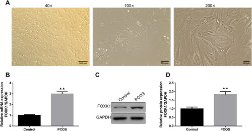 Figure 1. FOXK1 is highly expressed in PCOS-derived GCs. (A) The morphology of rat ovarian GCs was observed. (Magnification, 40×, 100×, 200×). (B) qRT-PCR was used to detect FOXK1 mRNA level in GCs of PCOS rats. (C,D) Western blot was used to detect FOXK1 protein expression level in GCs of PCOS rats. n = 3, compared to the control group, ▲p < .05, ▲▲p < .01. Note. FOXK1: forkhead box K1; PCOS: polycystic ovarian syndrome; GCs: granulosa cells; qRT-PCR: quantitative real-time PCR.