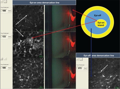Figure 3 In vivo scanning laser confocal microscopy after epithelial island cross-linking in thin corneas under 400 μm.