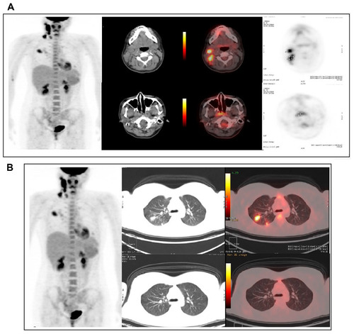 Figure 1 Fluorine-18 fluorodeoxyglucose PET/CT MIP and cross sectional images at the head and neck region and transthoracic level.
