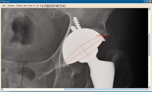 Figure 3. Post-operative radiograph of a United left total hip arthroplasty. Acetabular version was measured using Elliversion. In this case, half of the ellipse is not visible, and we could only assume the shape. This results in a bigger difference between the measurements. We defined radiographs of this kind as poor-quality radiographs.