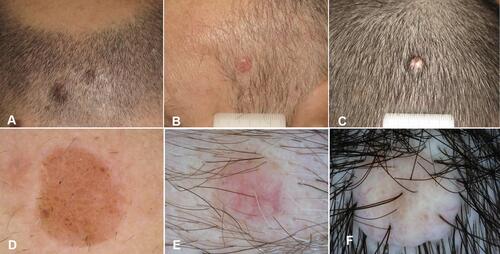 Figure 7 Scalp nevi in adults. (A–C) Clinical appearance of partially pigmented (A) and amelanotic (B and C) dome shaped papules. (D) In Dermoscopy, globular pattern in a compound nevus. (E and F) Dermoscopy of amelanotic lesions: blurred vascular pattern in two dermal nevi.