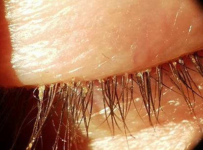 Figure 1 Patient with Demodex blepharitis and cylindrical dandruff at the base of the eyelashes.