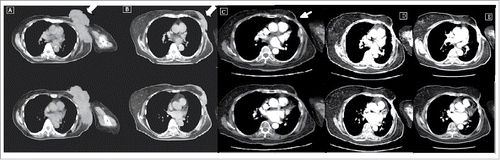 Figure 3. The axial computed tomography of the upper chest and axilla.(A) before radiotherapy; (B) Three months after radiosurgery, shrinkage of the local breast tumor (C) CT image after 1 year, nearly complete regression of locally breast tumor (D) CT image after 4 years, complete remission of the local breast tumor, we supposed that an abscopal effect had occurred. (E) Follow-up CT after 5 years confirmed a complete remission and the biopsy result showed fibrosis at the local tumor site.