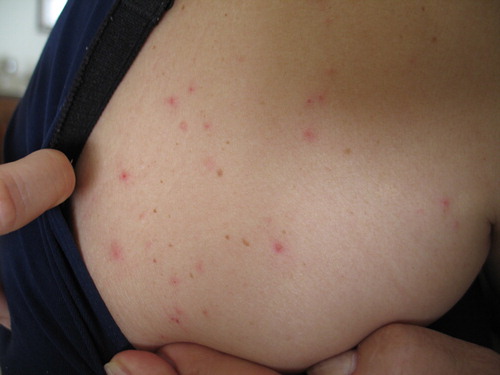 Figure 2. Dermanyssus gallinae-dermatitis caused by mites migrating from a sparrows’ nest (original, M.A. Cafiero).