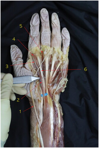 Figure 1. Dissection of the left wrist of an 85-year-old Korean female cadaver in the volar aspect. The anatomical structure of carpal tunnel was identified. We encountered an accessory first lumbrical muscle to the index finger within carpal tunnel (blue background). 1. Median nerve, 2. Accessory first lumbrical muscle, 3. Tendinous portion of the accessory first lumbrical muscle, 4. first lumbrical muscle, 5. Second lumbrical muscle, 6. Tendinous portion of flexor digitorum superficialis to the index finger.