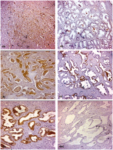 Figure 4. Immunohistochemical staining intensity scores. Prostate adenocarcinomas and non-malignant areas in same tissue sections stained with anti SP-D antibody (a) 1+ staining, (c) 2+ staining. Non-malignant areas stained with anti SP-D antibody (b) 1+ staining, (d) 2+ staining (e) 3+ staining. Negative control staining (nc). Note: Original magnifications of images; (a) 100×, (b) 50×, (c) 50×, (d) 50×, (e) 100, nc 50×.