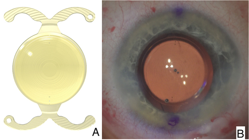 Figure 1 (A) FineVision HP toric intraocular lens with 4 C loop haptics, (B) FineVision HP toric intraocular aligned with preoperative marks placed on the positive axis based on corneal-derived aberrometry and the Zernike polynomial Z2.