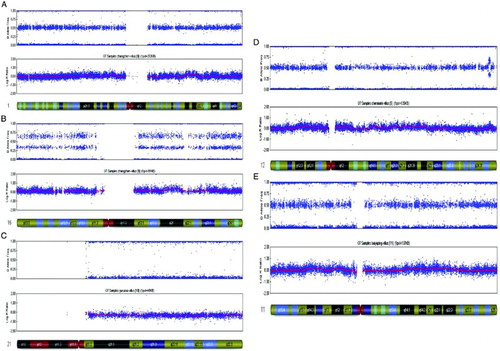 Figure 2.  Molecular karyocyte analysis of single nucleotide polymorphism microarray from spontaneous abortion. A) shows the normal diploid chromosome 1 diagnostic reading obtained from POC, Normal AA, AB, and BB alleles and a 0 reading for the smooth log R ratio is observed. B) shows the trisomy chromosome 16 diagnostic reading obtained from POC, AAA, AAB, ABB, and BBB alleles are observed and a significant shift in the smooth log R ratio is observed, consistent with the trisomy karyotype. C) shows the monosomy chromosome 21 diagnostic reading obtained from POC, AA, BB alleles are observed without AB and A significant shift in the smooth log R ratio is observed, consistent with the monosomy karyotype. D) demonstrates the duplication of q24.32 → q24.33 reading of chromosome 12. AAA, AAB, ABB, and BBB alleles are observed from q24.32 to q24.33. A significant shift in the smooth log R ratio is observed from q24.32 to q24.33 of chromosome 12. E) demonstrates the deletion of p11.12 → p11.23 reading of chromosome 11. AA,AB, and BB alleles are observed from p11.2 to pter and from q10 to qter of chromosome 11, however AA and BB alleles are observed without AB from p11.12 to p11.23 of chromosome 11 represented. A significant shift in the smooth log R ratio is observed from p11.12 to p11.23 of chromosome 11.