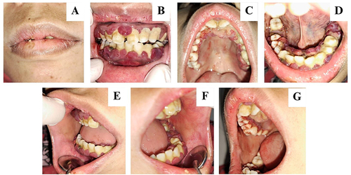 Figure 1 (A–G) Intraoral clinical feature at the first visit. The appeared gingival hyperplasia, erythema, soft consistency, a dark red, rounded gingival margin, and tendencies to bleed on the labial, buccal, palatal, and lingual regions.