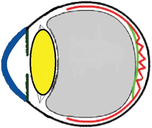 Figure 10 Schematic drawing of an eye with epiretinal membrane.