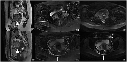 Figure 1. Patient number 13, 36 years old. (A–C) MR images before HIFU treatment; (D–F) MR images after HIFU treatment. A sagittal T2-weighted image (A) demonstrates anterior wall fibroids (triangle) that are almost hypointense on T2-weighted scans; (C) is a diffusion-weighted image. Fascial swelling has a stripe-like high-intensity signal (long arrow).